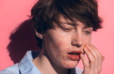 Facial Acne Concern &ndash; Person Touching Chin with Visible Skin Condition Against Pink Background, acne, skin, face, health, concern, dermatology, blemish, skincare