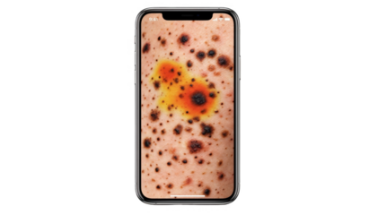 Isolated medical app interface on smartphone presenting AIgenerated heatmap of dark spots emphasizing clinical evaluation of skin pigmentation severity against white backdrop.