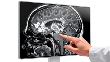 Closeup of a radiology reading room monitor showing brain MRI with white matter lesions a clinicians finger identifying affected areas on the screen.