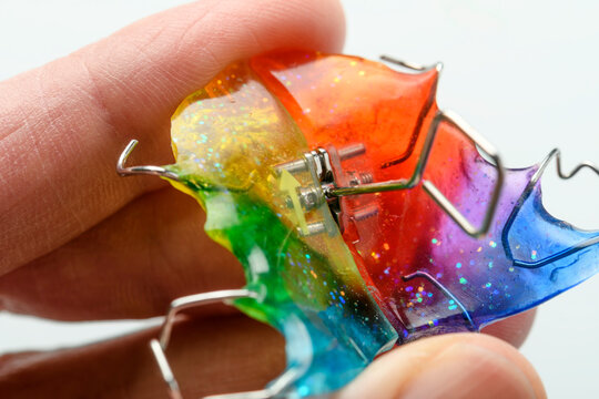 Macro view of rainbow glitter orthodontic palatal expander retainer in fingers, metal wires and screw on white background.
