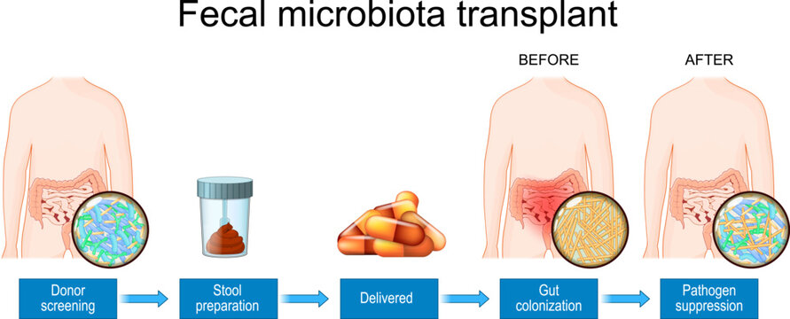 Fecal Microbiota Transplants. Microbiota of Patient before and after FMT procedure. Dysbiosis treatment