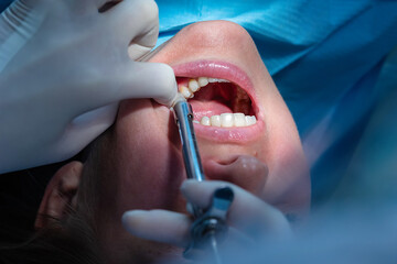 Close-up of dental anesthesia injection administered by a dentist before tooth treatment, pain management and restorative procedure in a modern dental clinic.