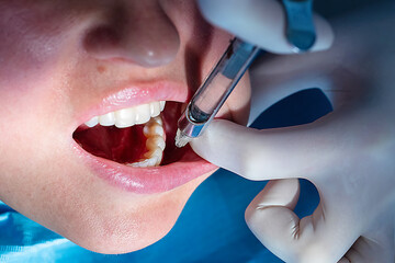 Close-up of dental anesthesia injection administered by a dentist before tooth treatment, pain management and restorative procedure in a modern dental clinic.