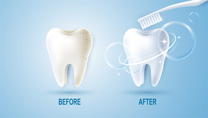 Set of dental cleaning and whitening teeth concept. comparison of clean and dirty tooth. dental health and oral hygiene poster for dentistry. examination teeth, whitening and repair. vector design.