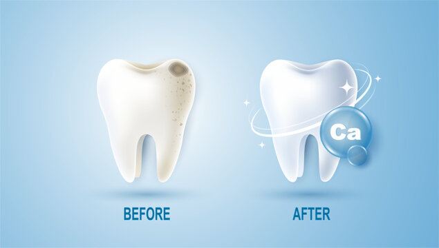 Set of dental cleaning and calcium for teeth concept. comparison of clean and dirty tooth. dental health and oral hygiene poster for dentistry. examination teeth, whitening and repair. vector design.