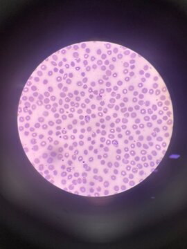 Plasmodium vivax Growing Trophozoite in Blood Smear &ndash; Microscopy
