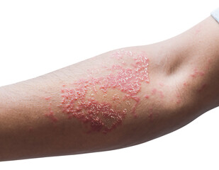 Fototapeta premium Human arm with severe chronic skin inflammation, showing red, scaly, flaky patches. Indicative of psoriasis, a, isolated on transparent background