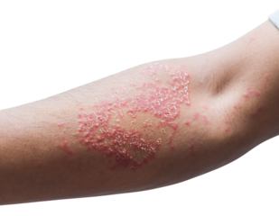 Human arm with severe chronic skin inflammation, showing red, scaly, flaky patches. Indicative of psoriasis, a, isolated on transparent background