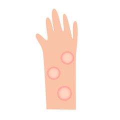 leprosy disease concept. vector illustration