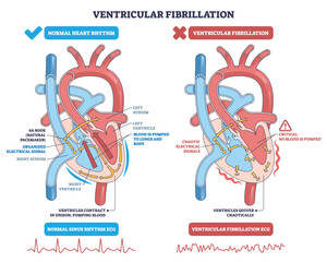 Ventricular fibrillation explained, side-by-side heart diagram contrasts normal rhythm with chaotic quivering, key elements are ventricles, electrical signals, and ECG traces. Outline diagram
