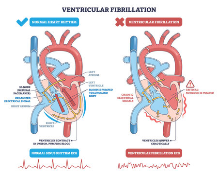 Ventricular fibrillation explained, side-by-side heart diagram contrasts normal rhythm with chaotic quivering, key elements are ventricles, electrical signals, and ECG traces. Outline diagram