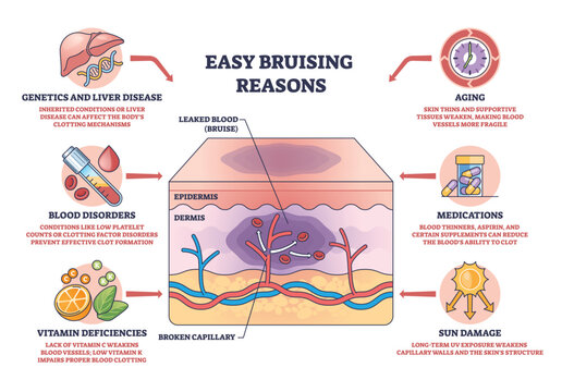 Easy bruising reasons diagram illustrates skin layers with broken capillary and leaked blood forming a bruise, key objects, skin cross-section, capillary, bruise. Outline diagram