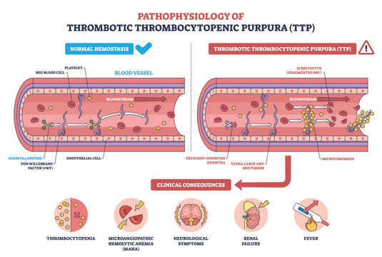 TTP pathophysiology illustrated, ADAMTS13 deficiency leads to ultra-large vWF, platelet-rich microthrombi in a blood vessel, key items are platelets, RBCs, microthrombus. Outline diagram