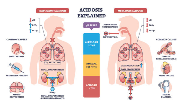 Acidosis explained contrasts respiratory and metabolic imbalance, lungs, kidneys, and pH scale highlight CO2 retention and acid buildup for quick understanding. Outline diagram