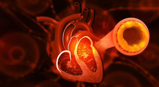 Atherosclerosis, Human Heart Anatomy with a Severely Blocked Coronary Artery due to Cholesterol Plaque Buildup. 3d illustration