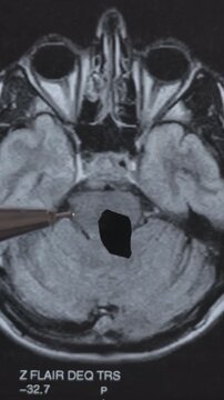Vertical footage of CT scan of human brain. Examining disease.