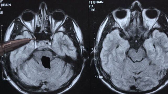 CT scan of human brain. Examining disease. Close up footage.