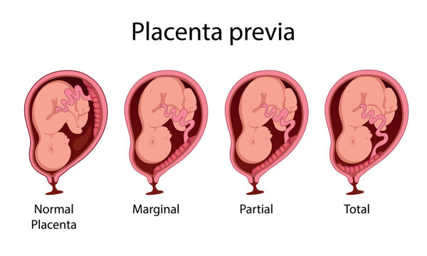 Different location of the Placenta during Pregnancy. Major, normal, total and partial placenta previa. Pathology. vector illustration.
