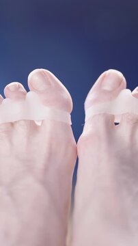 Feet with soft silicone toe corrector fixing hallux valgus close-up