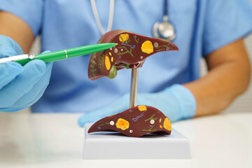 Cirrhosis, Liver cancer, fatty liver, Asian doctor with liver human anatomy model in World Hepatitis Day at hospital.