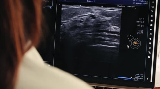 A doctor reviews an ultrasound of the mammary glands image on a computer screen in office, as part of a breast cancer screening process. High quality 4k footage