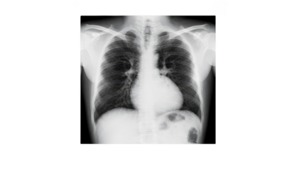 Isolated large cardiac silhouette Xray print on a white background emphasizing heart enlargement in heart failure cases for clinical and educational use.