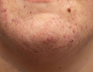 Fototapeta premium A person with a red rash on their chin