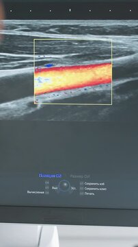 ultrasound screen showing turbulent flow within vessel, vivid color mosaic fills measurement box emergency sonographer captures abnormal pattern during bedside exam while cardiologist evaluates