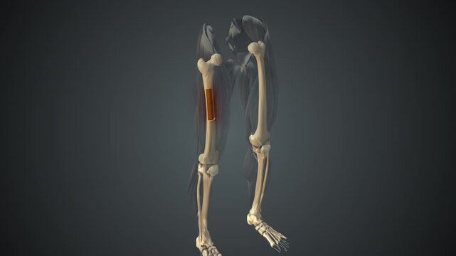 Metastatic involvement of femoral bone marrow
