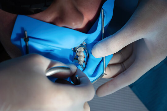 Close-up of dentist placing a metal matrix and clamp to restore a cervical tooth defect. Precise dental technique used during composite filling in modern clinic.