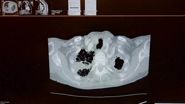 CT Chest - Mycobacterium chelonae and left upper lobe mycetoma