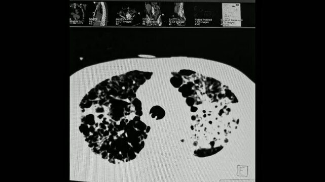 CT Chest - Mycobacterium chelonae and left upper lobe mycetoma