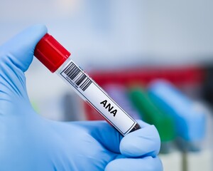 Blood sample tube for anti-nuclear antibody (ANA) test analysis. © kitsawet