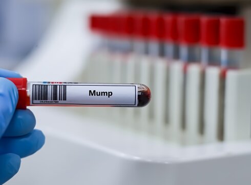 Blood sample tube for mump test analysis.