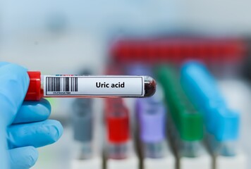 Fototapeta premium Blood sample tube for uric acid test analysis.