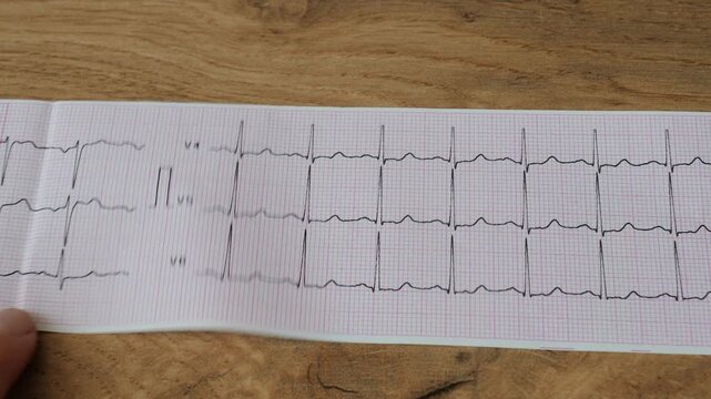 Doctor is looking at the patient's electrocardiogram ECG, EKG