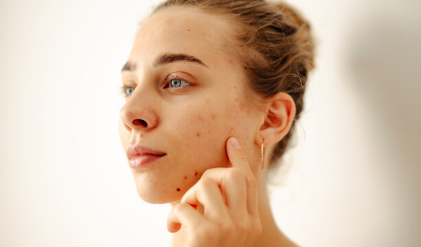 A close-up of a young woman with skin imperfections looks into a small mirror in a bright room. A beautiful woman touches her blemishes indoors. Concept of acne, dermatology.