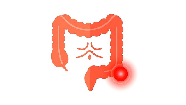 Illustration of the human colon with a diverticulum highlighted.