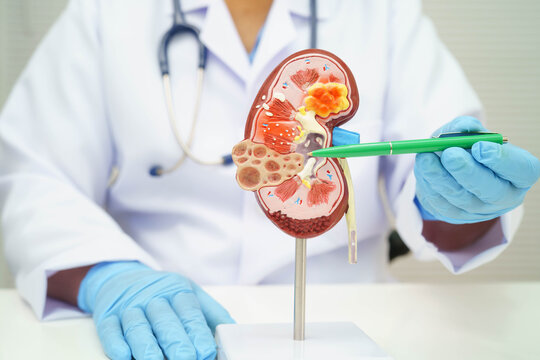 Chronic kidney disease, doctor with model for treatment urinary system, urology, Estimated glomerular filtration rate eGFR.