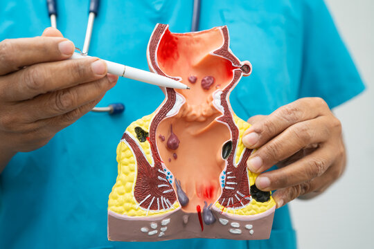 Asian doctor with rectum and hemorrhoid human model, inflamed vascular structure.