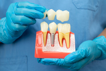 Asian dentist holding dental implant, artificial tooth roots into jaw, root canal of dental...