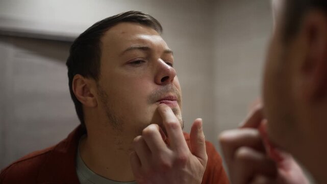 Worried man in front of a mirror applying cream to a cold sore on his lip, showcasing the discomfort and treatment of a herpes simplex virus infection on his face at home