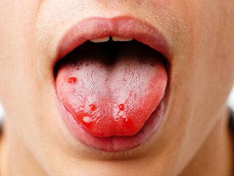 Close up of human tongue with red sores and white coating mouth ulcer