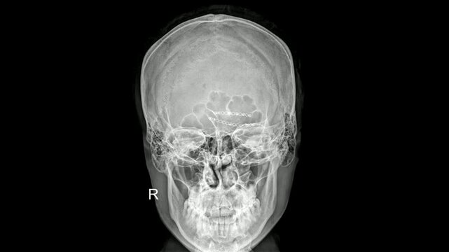 Frontal Skull X-ray Showing Cranial Implants 