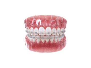 Dental model with metallic braces and pink gums teeth