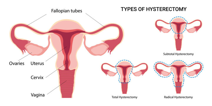 Hysterectomy. Surgical removal of the uterus. Total, radical, subtotal. Female anatomy. Vector Medical diagram for gynecology. 
