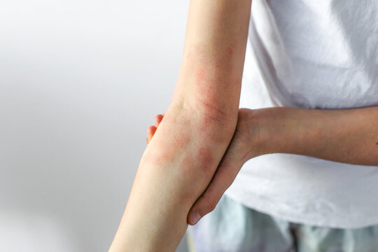 Child forearm with visible eczema irritation red patches, sensitive dry skin affected by atopic dermatitis, pediatric dermatology concept showing chronic allergy symptoms skin condition, copyspace