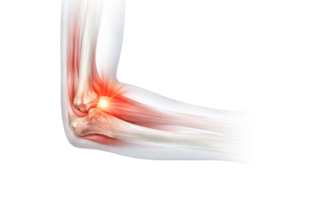 Human elbow joint anatomy with bones muscles tendons ligaments and inflammation pain area detailed medical illustration isolated on white background