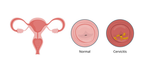Cervicitis, inflammation of the cervix, and normal cervix comparison