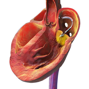 Transcatheter edge-to-edge repair of the heart, illustration
